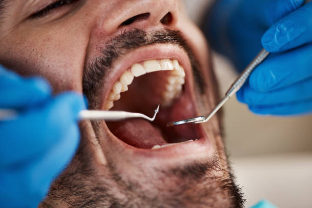 Best Emergency Wisdom Tooth Extraction in Palm Beach, FL